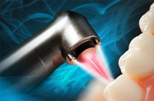 Laser periodontal