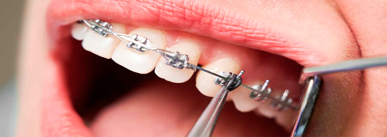 Alicates para Ortodoncia